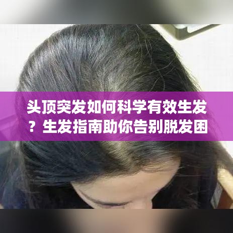 頭頂突發(fā)如何科學(xué)有效生發(fā)？生發(fā)指南助你告別脫發(fā)困擾！