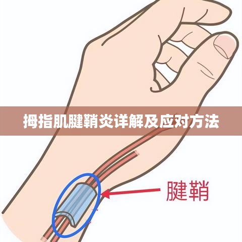拇指肌腱鞘炎詳解及應對方法